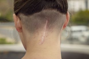 Skład i budowa blizn skóry różnią się w zależności od płci